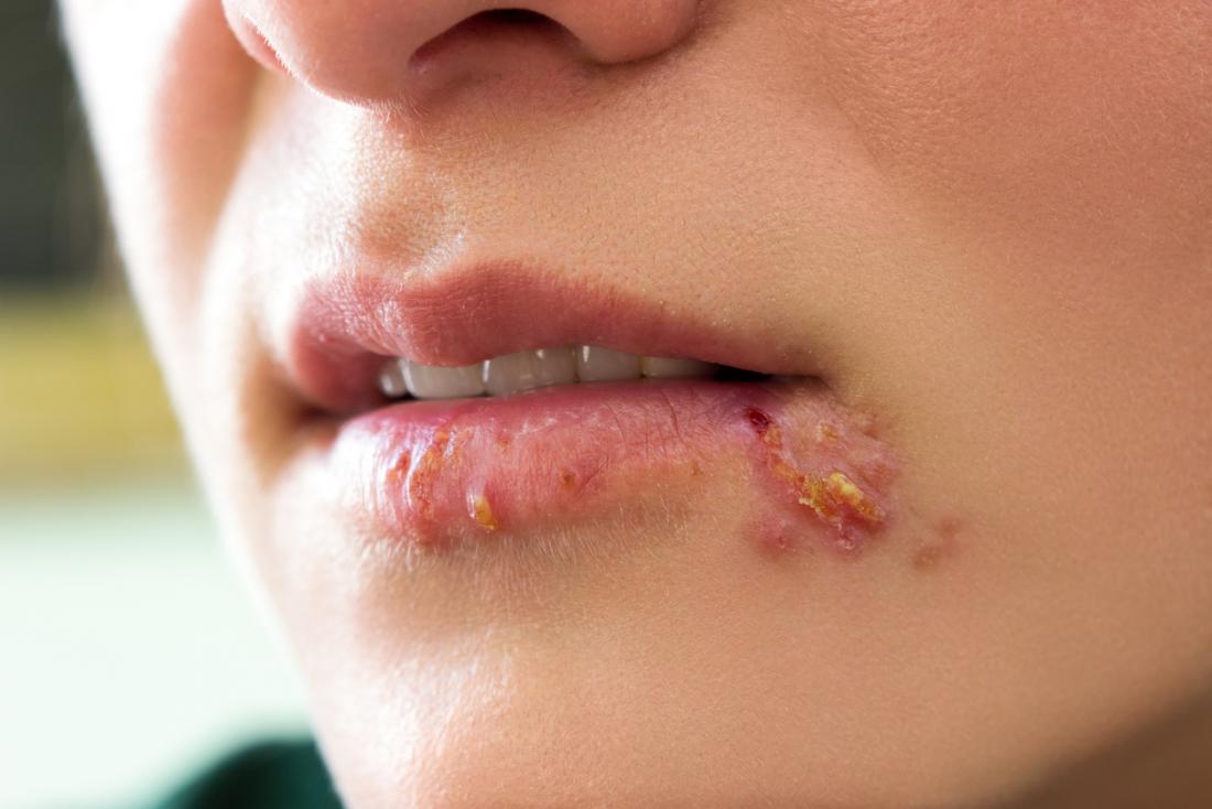 Billions globally living with herpes – WHO