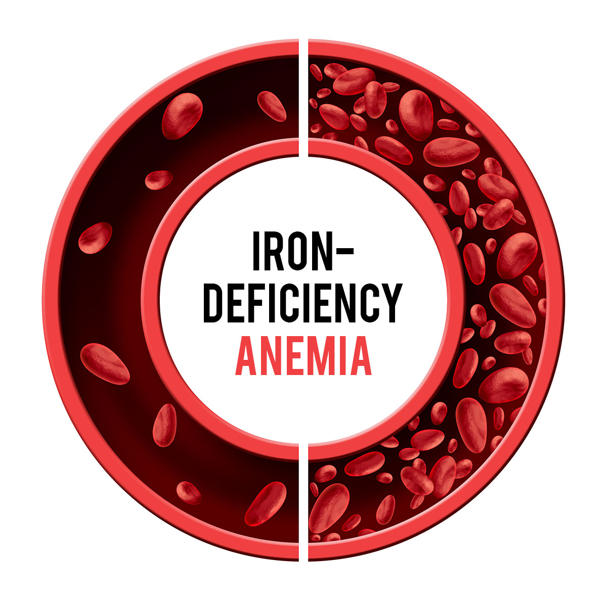 Iron deficiency can affect sexual performance in men - Nutritionist